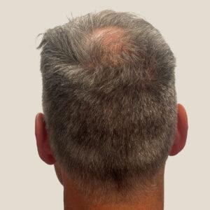 Dane, 62 años, hombre, trasplante capilar Micro PUE® en Chicago, coronilla, 2773 injertos, resultados antes y después