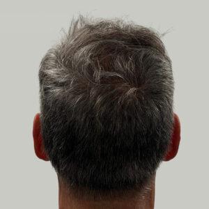 Dane, 62 años, hombre, trasplante capilar Micro PUE® en Chicago, coronilla, 2773 injertos, resultados antes y después
