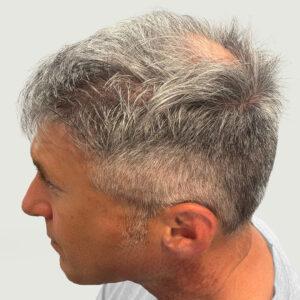 Dane, 62 años, hombre, trasplante capilar Micro PUE® en Chicago, coronilla, 2773 injertos, resultados antes y después