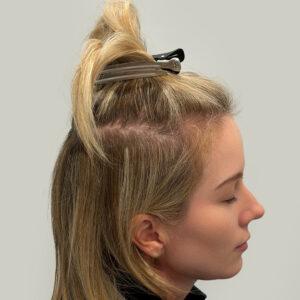 Eleanor, woman, medical hair loss treatment Chicago, before and after photos
