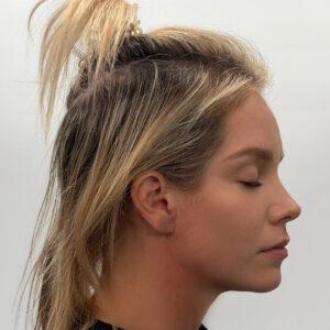 Eleanor, woman, medical hair loss treatment Chicago, before and after photos