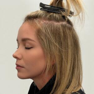 Eleanor, woman, medical hair loss treatment Chicago, before and after photos