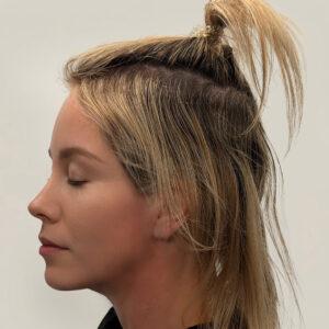 Eleanor, woman, medical hair loss treatment Chicago, before and after photos