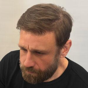Grant, 48, man, medical hair loss treatment Chicago, before and after photos
