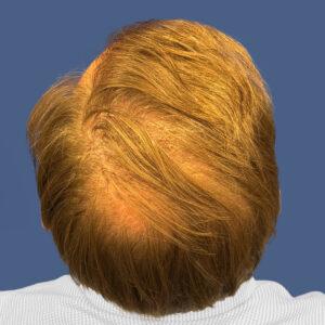 Grant, 48, man, medical hair loss treatment Chicago, before and after photos