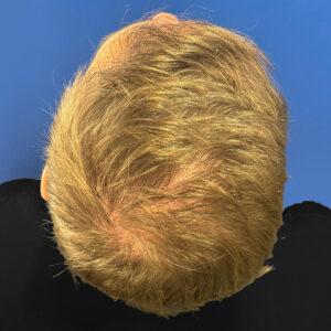 Grant, 48, man, medical hair loss treatment Chicago, before and after photos