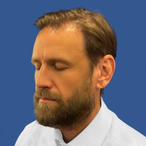 Grant, 48, man, medical hair loss treatment Chicago, before and after photos