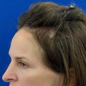 Jillian, woman, medical hair loss treatment Chicago, before and after pictures