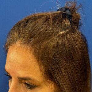 Jillian, woman, medical hair loss treatment Chicago, before and after pictures