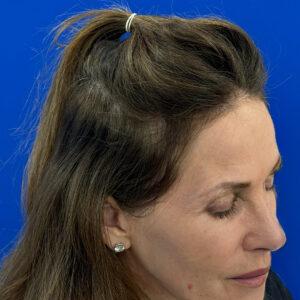 Jillian, woman, medical hair loss treatment Chicago, before and after pictures