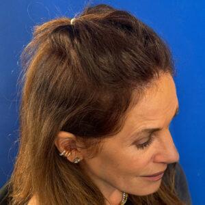 Jillian, woman, medical hair loss treatment Chicago, before and after pictures