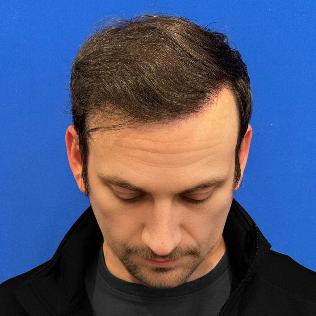 Larry, 39, man, revision FUE hair transplant Chicago, hairline, 2,916 grafts, before and after results