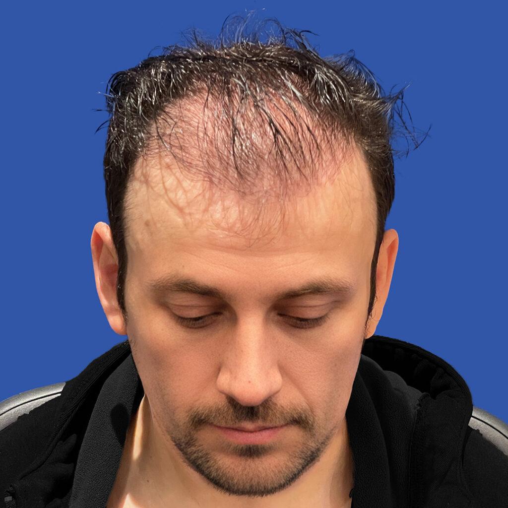 Larry, 39, man, revision FUE hair transplant Chicago, hairline, 2,916 grafts, before and after results