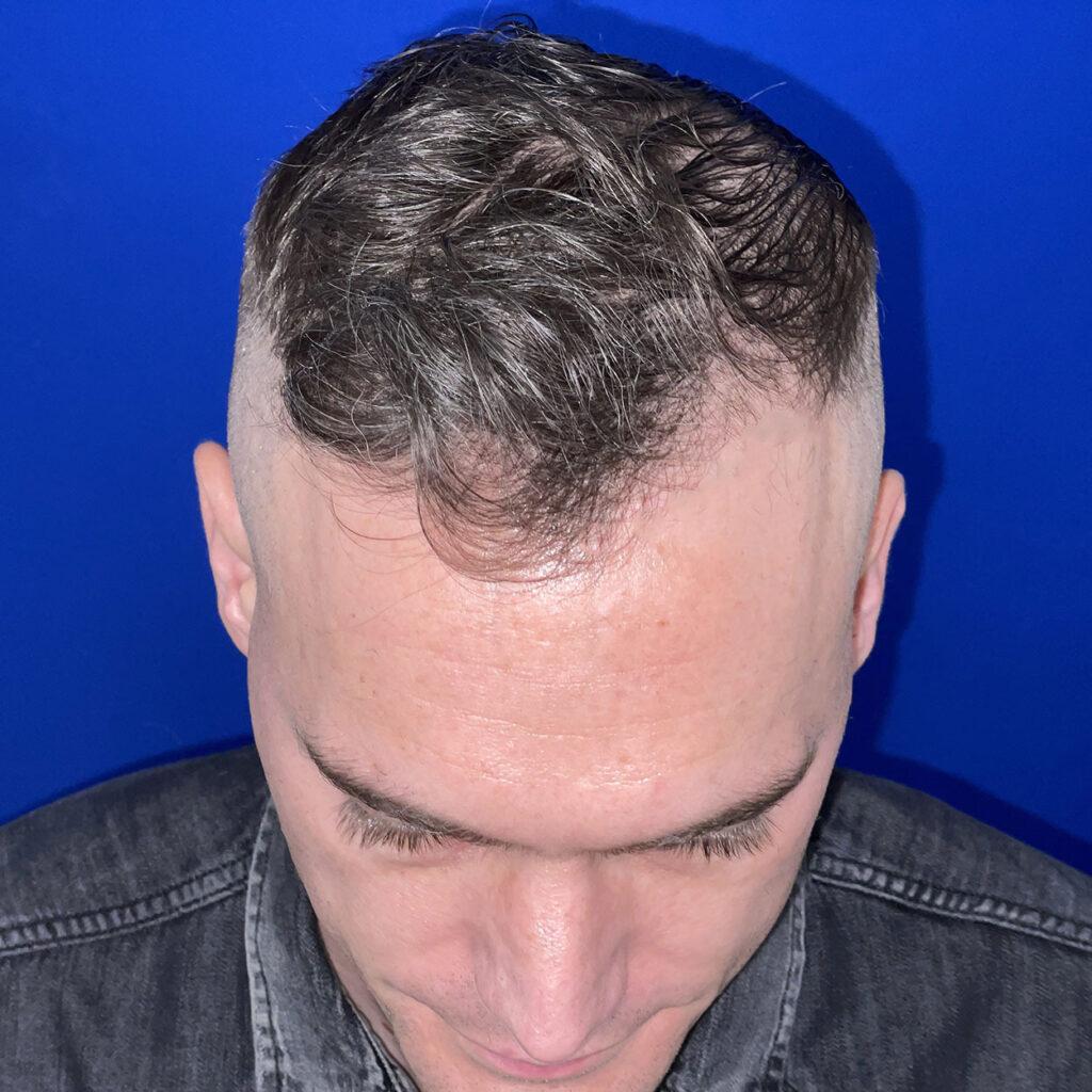 Matt, 46, man, FUE hair transplant Chicago, hairline, 1,050 grafts, before and after pictures
