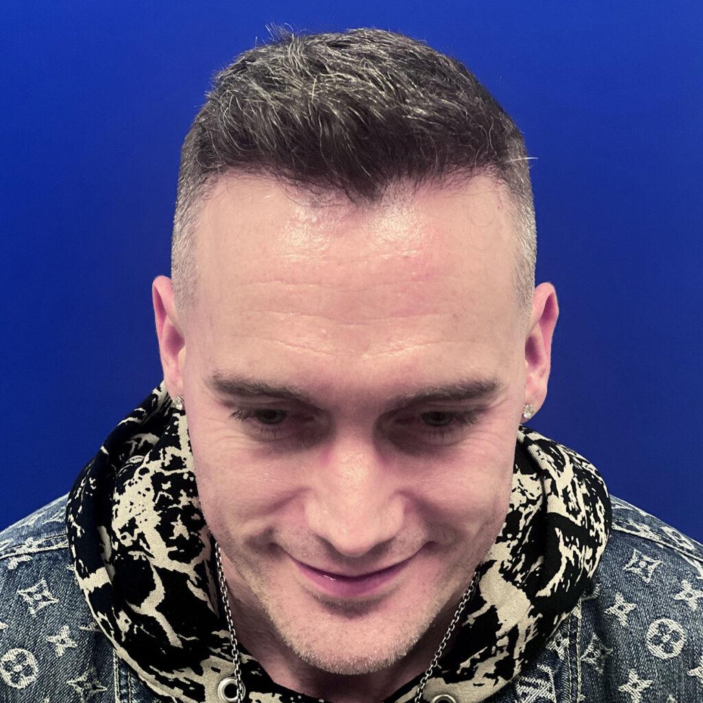 Matt, 46, man, FUE hair transplant Chicago, hairline, 1,050 grafts, before and after pictures