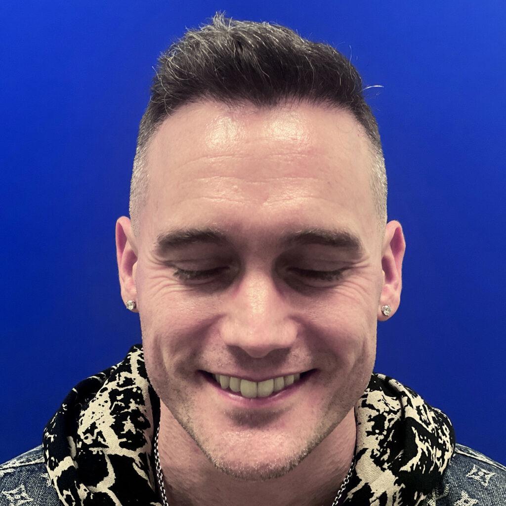 Matt, 46, man, FUE hair transplant Chicago, hairline, 1,050 grafts, before and after pictures