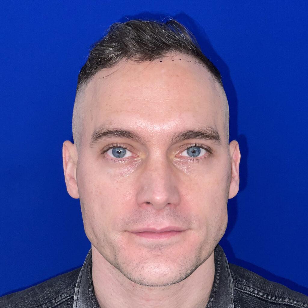 Matt, 46, man, FUE hair transplant Chicago, hairline, 1,050 grafts, before and after pictures