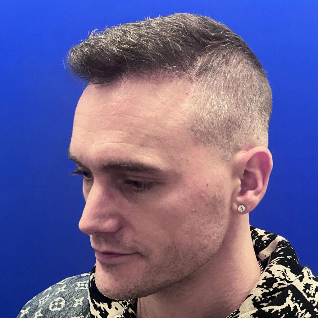 Matt, 46, man, FUE hair transplant Chicago, hairline, 1,050 grafts, before and after pictures