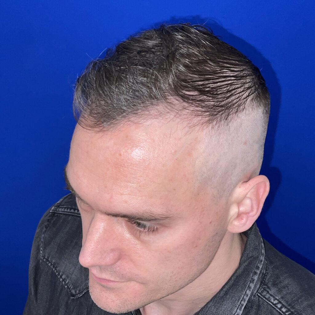 Matt, 46, man, FUE hair transplant Chicago, hairline, 1,050 grafts, before and after pictures