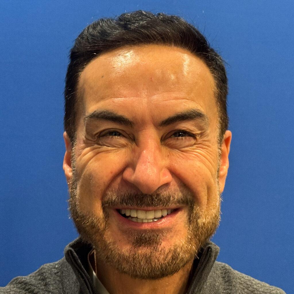 Ray, 61, Middle Eastern man, Micro PUE® hair transplant Chicago, 4,098 grafts, 2 sessions, before and after pictures
