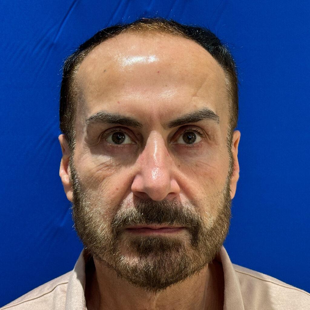 Ray, 61, Middle Eastern man, Micro PUE® hair transplant Chicago, 4,098 grafts, 2 sessions, before and after pictures
