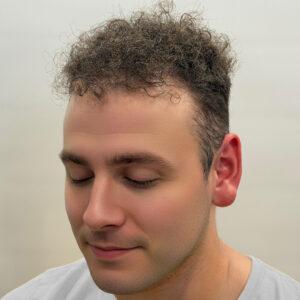 Zeke, 19, man, Micro PUE® hair transplant Chicago, hairline and crown, 6,924 grafts, mega session, before and after pictures