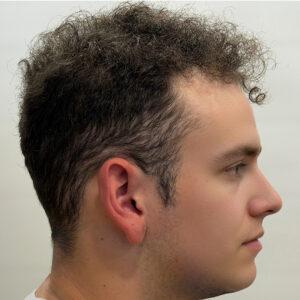 Zeke, 19, man, Micro PUE® hair transplant Chicago, hairline and crown, 6,924 grafts, mega session, before and after pictures