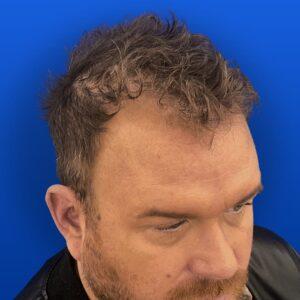 Jim, 31, man, Micro PUE® hair transplant Chicago, hairline, 3,018 grafts, before and after photos
