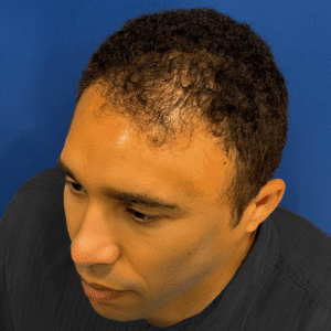 Dominic, 45, African American man, Micro PUE® hair transplant Chicago, hairline, 3,127 grafts, before and after pictures