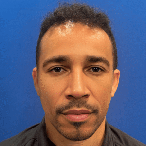 Dominic, 45, African American man, Micro PUE® hair transplant Chicago, hairline, 3,127 grafts, before and after pictures