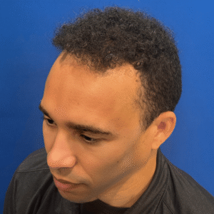 Dominic, 45, African American man, Micro PUE® hair transplant Chicago, hairline, 3,127 grafts, before and after pictures
