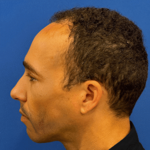 Dominic, 45, African American man, Micro PUE® hair transplant Chicago, hairline, 3,127 grafts, before and after pictures