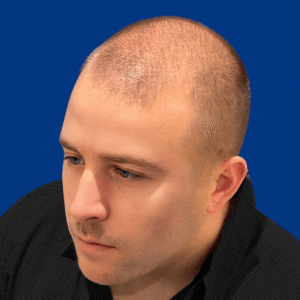 Elliot, 30, man, FUE hair transplant Chicago, hairline, 2,808 grafts, before and after photos