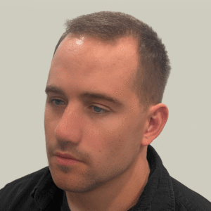 Elliot, 30, man, FUE hair transplant Chicago, hairline, 2,808 grafts, before and after photos
