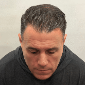 Franco, 53, man, Micro PUE® hair transplant Chicago, hairline, 3,010 grafts, before and after photos