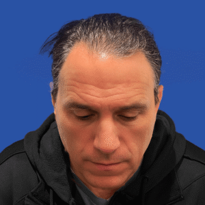 Franco, 53, man, Micro PUE® hair transplant Chicago, hairline, 3,010 grafts, before and after photos