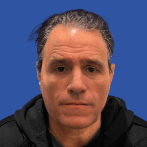Franco, 53, man, Micro PUE® hair transplant Chicago, hairline, 3,010 grafts, before and after photos