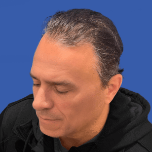 Franco, 53, man, Micro PUE® hair transplant Chicago, hairline, 3,010 grafts, before and after photos