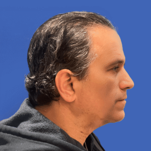 Franco, 53, man, Micro PUE® hair transplant Chicago, hairline, 3,010 grafts, before and after photos