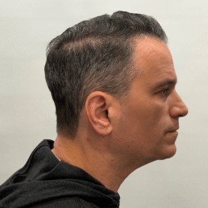 Franco, 53, man, Micro PUE® hair transplant Chicago, hairline, 3,010 grafts, before and after photos