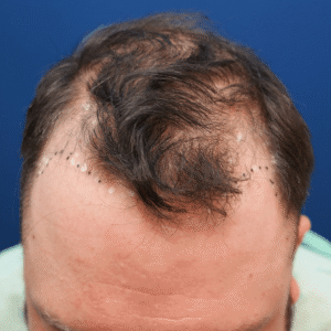 Jeff, man, FUE hair transplant Chicago, hairline, before and after photos