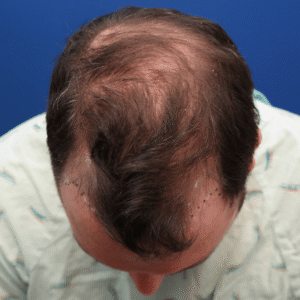 Jeff, man, FUE hair transplant Chicago, hairline, before and after photos