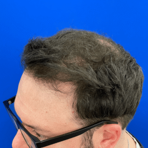 Jeff, man, FUE hair transplant Chicago, hairline, before and after photos