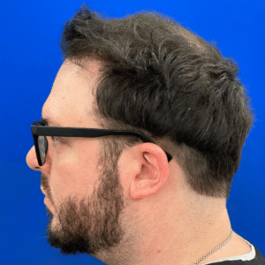 Jeff, man, FUE hair transplant Chicago, hairline, before and after photos