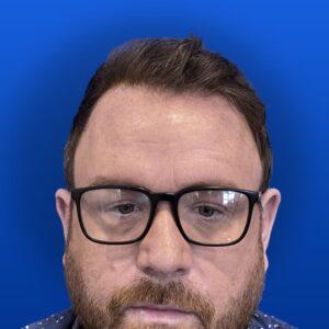 Jim, 31, man, Micro PUE® hair transplant Chicago, hairline, 3,018 grafts, before and after photos