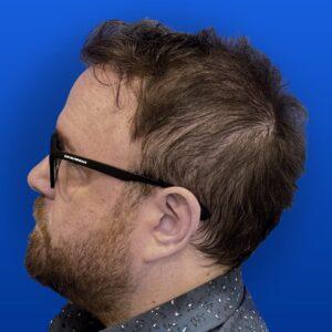 Jim, 31, man, Micro PUE® hair transplant Chicago, hairline, 3,018 grafts, before and after photos