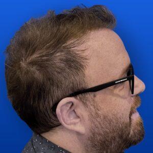 Jim, 31, man, Micro PUE® hair transplant Chicago, hairline, 3,018 grafts, before and after photos
