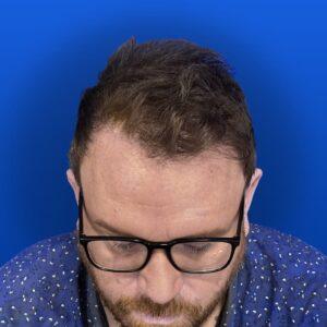 Jim, 31, man, Micro PUE® hair transplant Chicago, hairline, 3,018 grafts, before and after photos