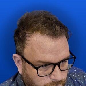 Jim, 31, man, Micro PUE® hair transplant Chicago, hairline, 3,018 grafts, before and after photos