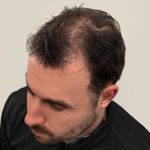 Jonas, 31, man, FUE hair transplant Chicago, 4,285 grafts, 2 sessions, before and after results